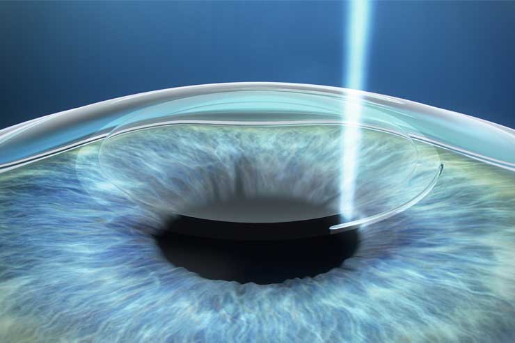 +1 (954) 563-3450+Optometry+Fort+Lauderdale+Wave+Light+Auto+Refracting+95+Percent+Accurate+Comprehensive+Exams+Ocular+Health+Contact+Lens+Fittings