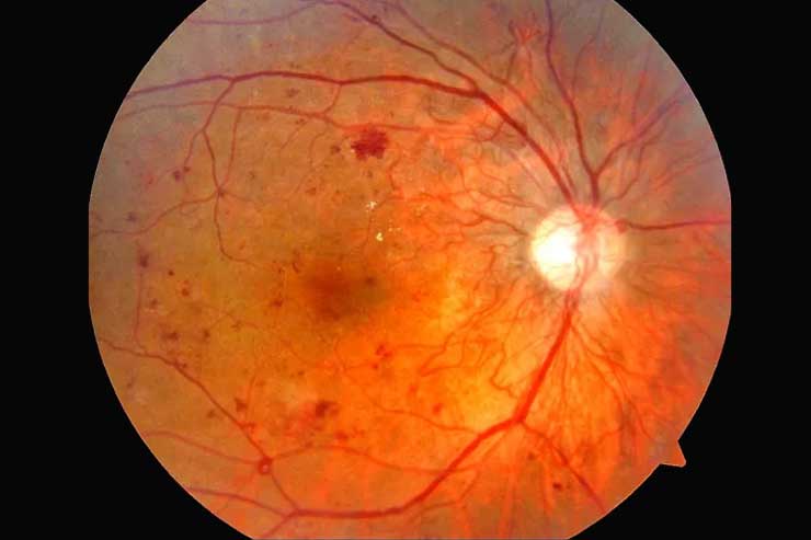 Diabetic-Eye-Disease